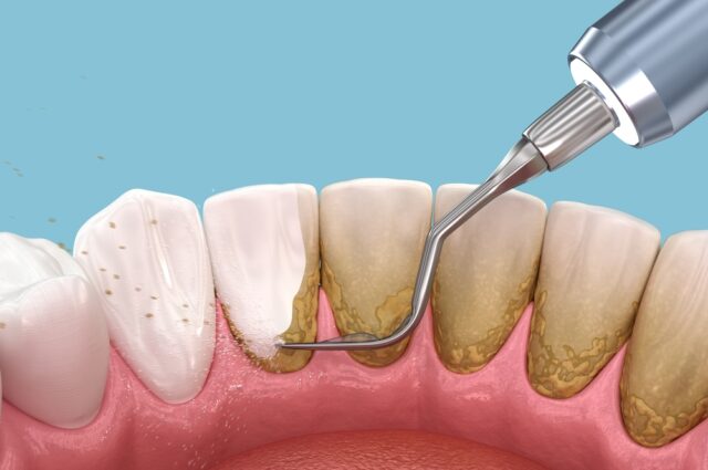 Teeth Cleaning Aftercare